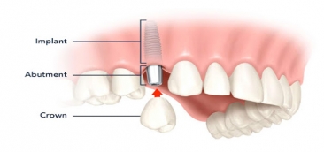 Cấy răng Implant - "Cứu tinh cho nỗi khổ mất răng"